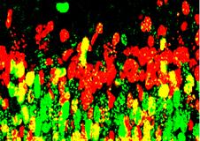 Living with dystonia – personal perspectives